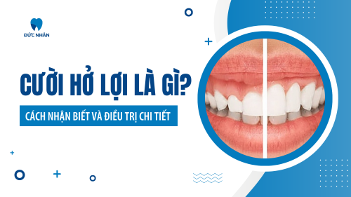 Cười hở lợi - Cách nhận biết mức độ và phương pháp điều trị